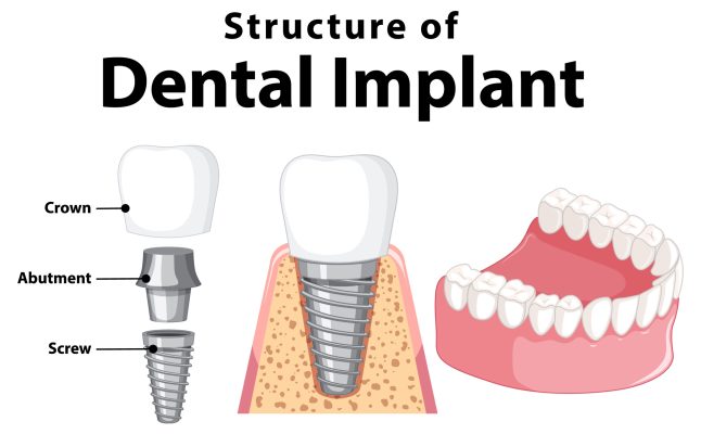 Infographic of human in structure of the dental implant illustration