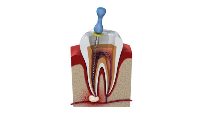 Root-Canal